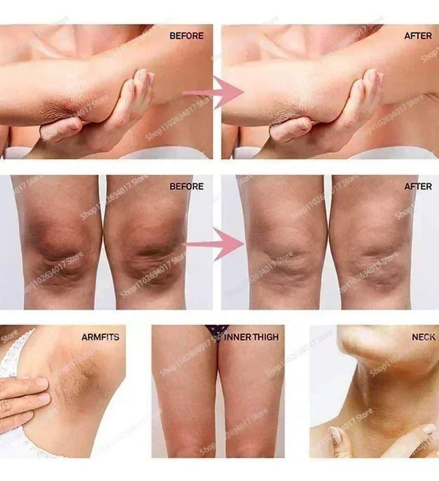 HOT~Whitening Cream Private Parts Underarm Bleaching Serum Whiten Butt Knee Brighten Inner Thigh Intimate Parts Dark Remove Mela