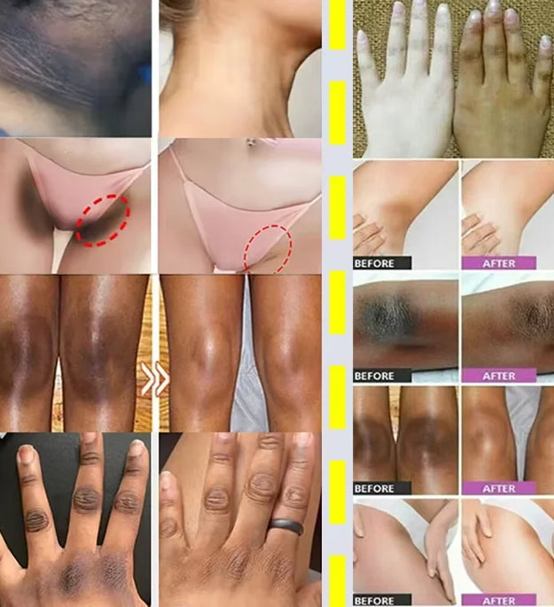 Niacinamide Whitening Cream Stick Remove Dark Spots Bleaching Private Parts Underarm  Brighten Butt Knee Inner Thigh Body Care