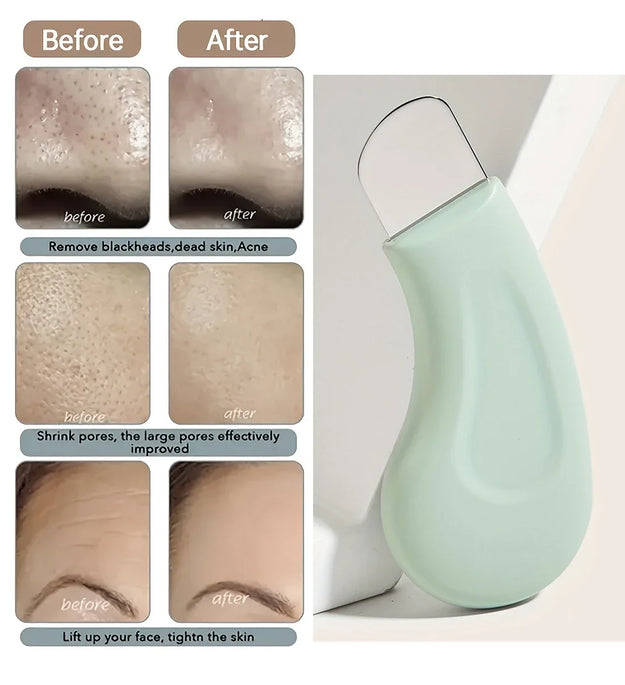 Blackhead and Whitehead Removal Tool for Nose and Face - Skin Pore Cleaner Skin Care Tools for Women