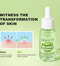 AUQUEST Herbal Acne Treatment Face Serum Salicylic Acid Oil Control Pimple Remover Facial Acne Removal Skin Care - BlissFully