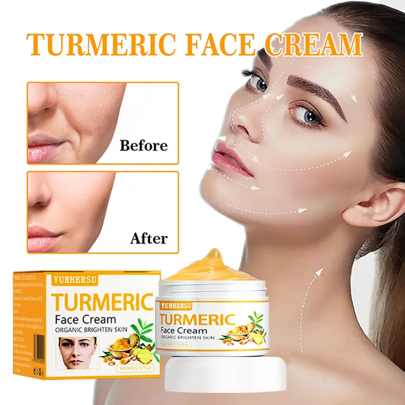 Anti Acne Turmeric Cream, Fades Scars & Dark Spots, for Oily and Dull Skin, Brightening Turmeric Face Care Treatment, 50ml - BlissFully
