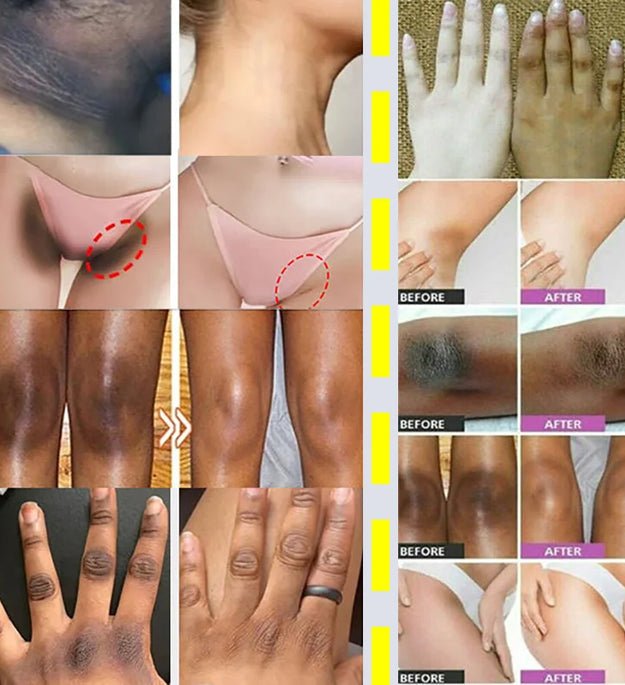Whitening Cream Private Parts Underarm Bleaching Serum Whiten Butt Knee Brighten Inner Thigh Intimate Parts Dark Remove Melanin