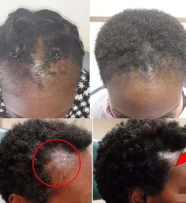 Fast Hair Growth Set Batana Oil Traction Alopecia Hair Mask Anti Break Loss Hair Growth Oil Baldness Treatment Hair Health Care