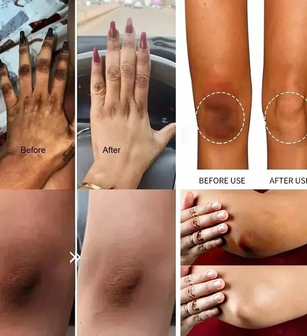 Whitening Cream Private Parts Underarm Bleaching Serum Whiten Butt Knee Brighten Inner Thigh Intimate Parts Dark Remove Melanin