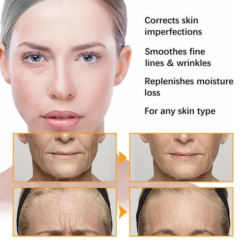 Anti Acne Turmeric Cream, Fades Scars & Dark Spots, for Oily and Dull Skin, Brightening Turmeric Face Care Treatment, 50ml - BlissFully