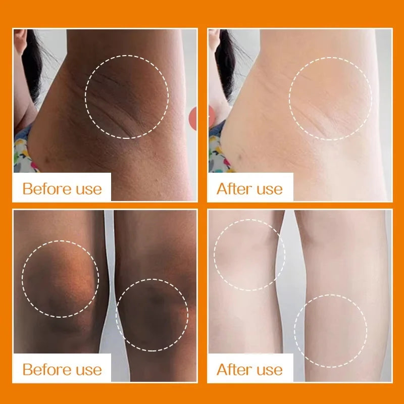 Nicotinamide Whitening Cream For Dark Skin Effective Lighten Thigh Inner Bleach Remove Melanin Private Parts Brightening Cream