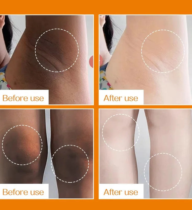 Nicotinamide Whitening Cream For Dark Skin Effective Lighten Thigh Inner Bleach Remove Melanin Private Parts Brightening Cream