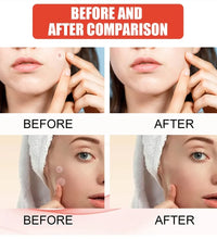 240pcs Star Acne Patches Invisible Pimple Cover for Face Oil Control Spot Treatment Cute Sticker for Covering Zits and Blemishes - BlissFully