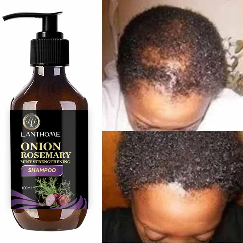 100ML Hair Shampoo For Fast Hair Growth Rosemary Onion Shampoo 30ML Spray Anti Hair Loss Effective Within 7 Day Hair Growth - BlissFully