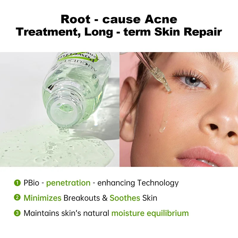 AUQUEST Herbal Acne Treatment Face Serum Salicylic Acid Oil Control Pimple Remover Facial Acne Removal Skin Care - BlissFully