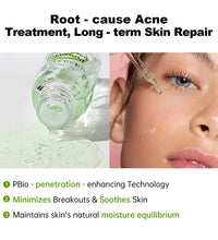 AUQUEST Herbal Acne Treatment Face Serum Salicylic Acid Oil Control Pimple Remover Facial Acne Removal Skin Care - BlissFully