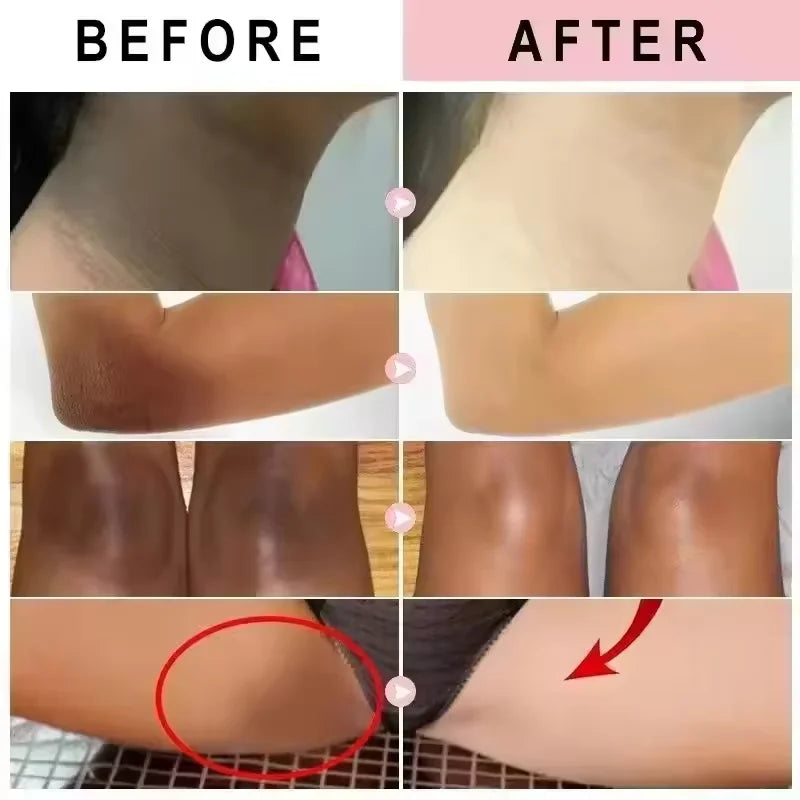Body Whitening Cream Dark Skin Armpit Lightening Intimate Areas Underarm Bleaching Private Parts Whiten Cream Body Lotion Beauty