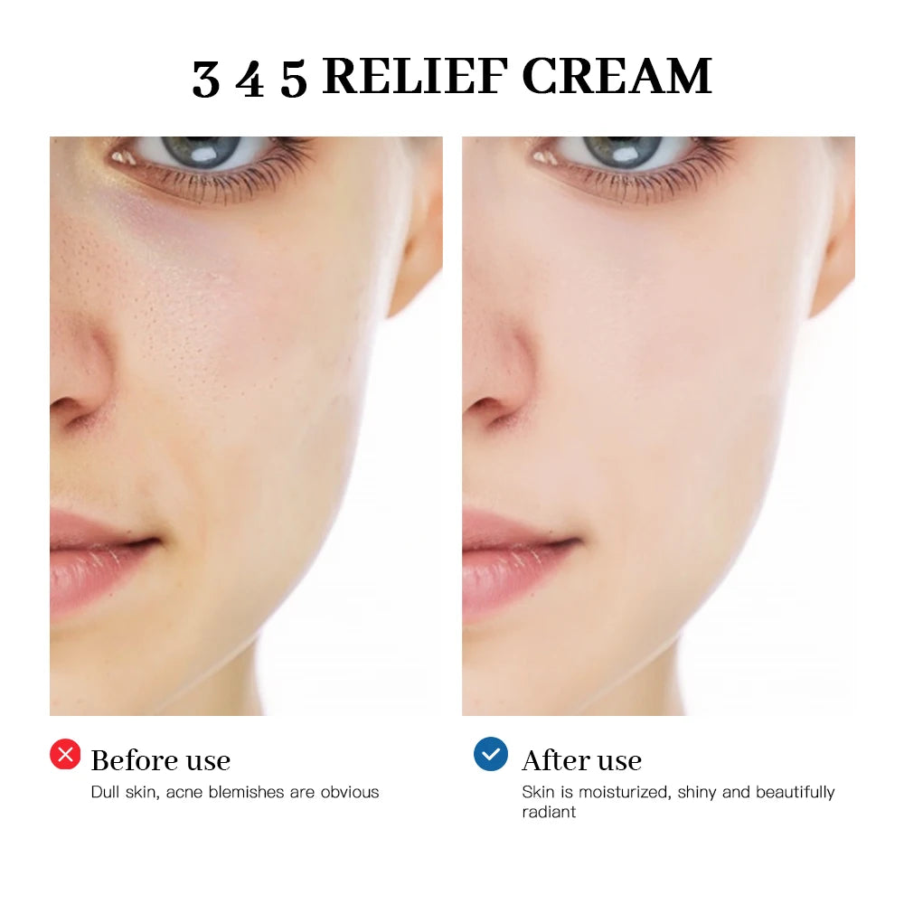 345 Relief Cream Comprehensive solution to skin problems Anti-sugar and antioxidant Brightening skin Improving acne marks Moistu - BlissFully