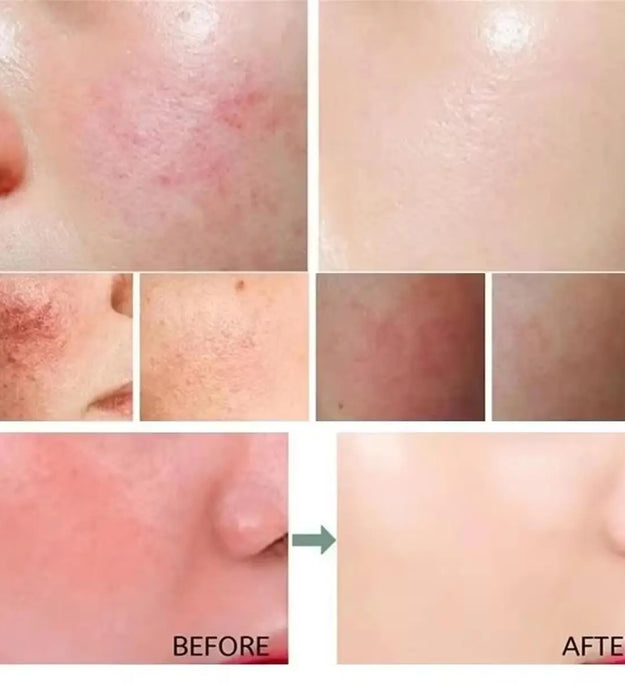 Repair Facial Redness Cream Instant Spider Vein Remove Sensitive Skin Sooth Anti Redness Rosacea Treat Lotion Korean Cosmetics - BlissFully