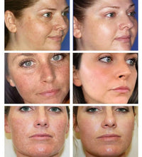 Whitening Freckles Cream Remove Melasma Dark Spot Lightening Melanin Brightening Melasma Remover Moisturize Anti-aging Face Care - BlissFully