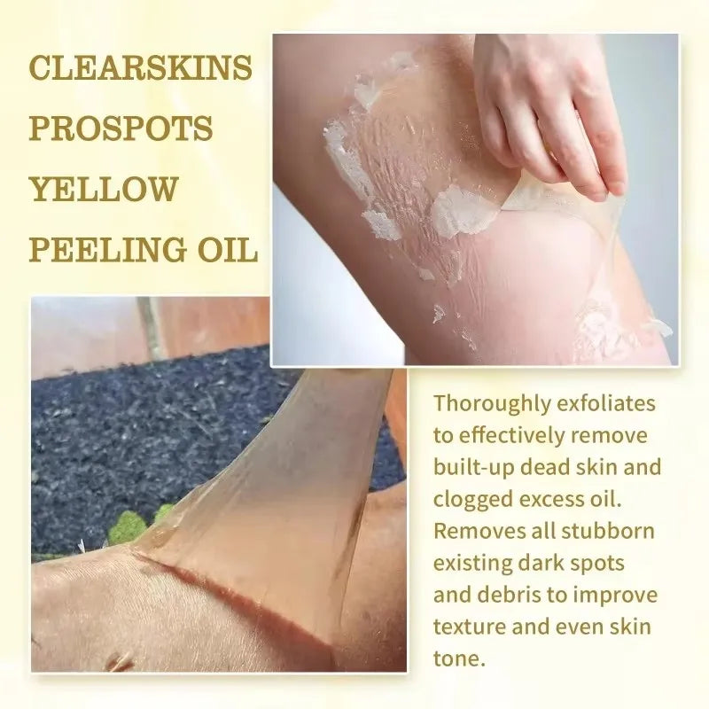 Strong Yellow Peeling Oil Bleach Dark Skin Whiten Lotion Lighten Body Elbow Knee Hand Exfoliate Dead Skin Nourish Even Skin Tone - BlissFully